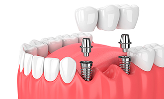 Dental Implanta to Replace All Teeth